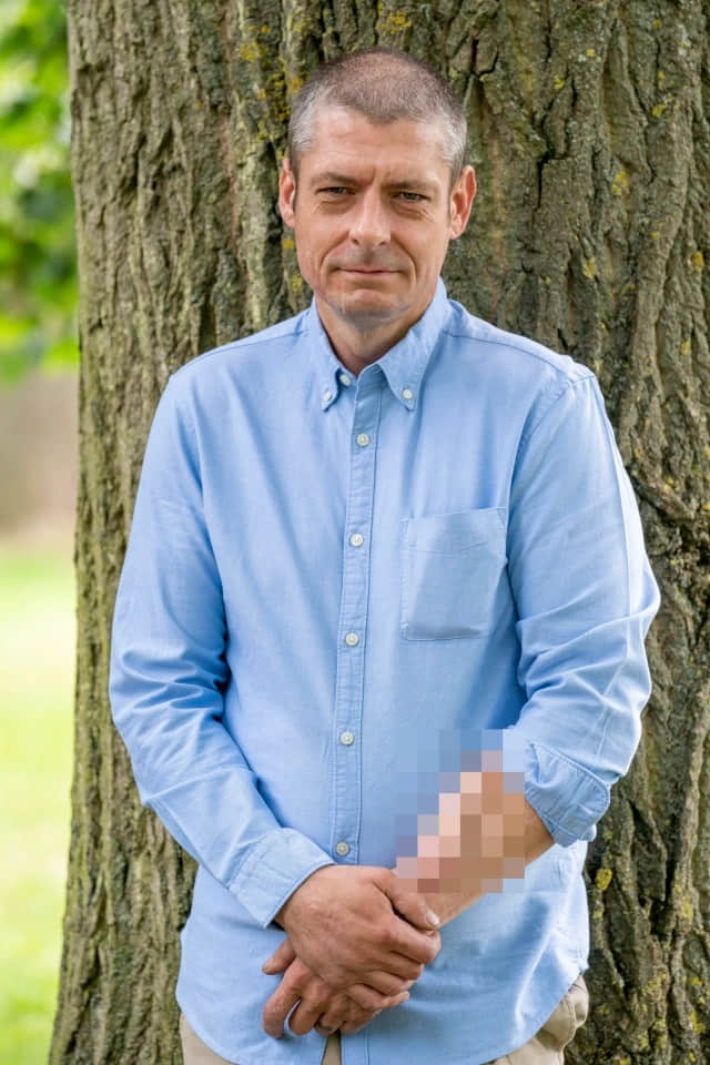全球首位前臂长出生殖器的男人 背后原因令人意想不到 -2 全球首位前臂长出生殖器的男人 背后原因令人意想不到-NICEOLO
