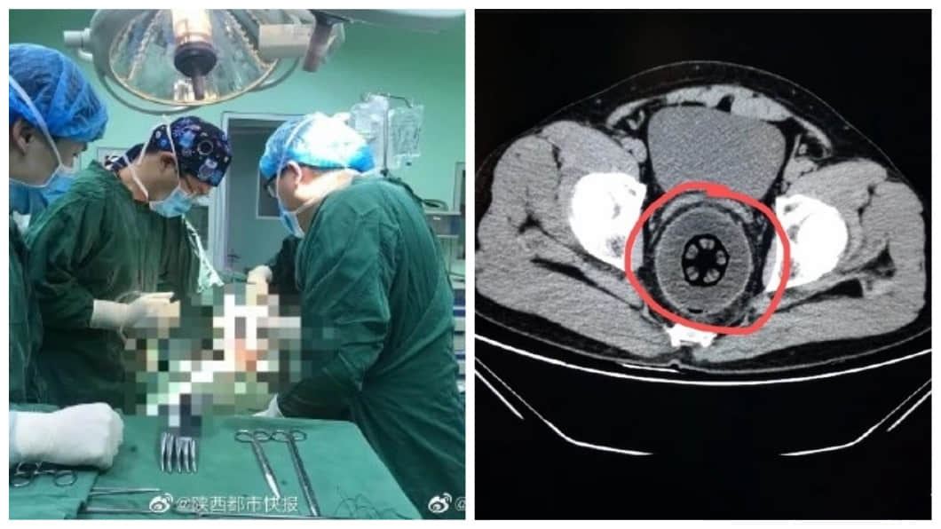 超狂男子腹痛6小时羞求医，直肠惊现20公分大木瓜：不小心塞进去的...-NICEOLO