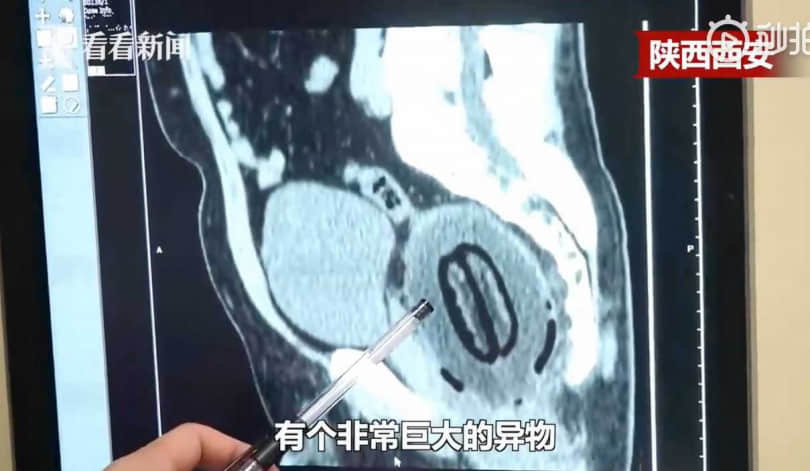 超狂男子腹痛6小时羞求医，直肠惊现20公分大木瓜：不小心塞进去的...-NICEOLO